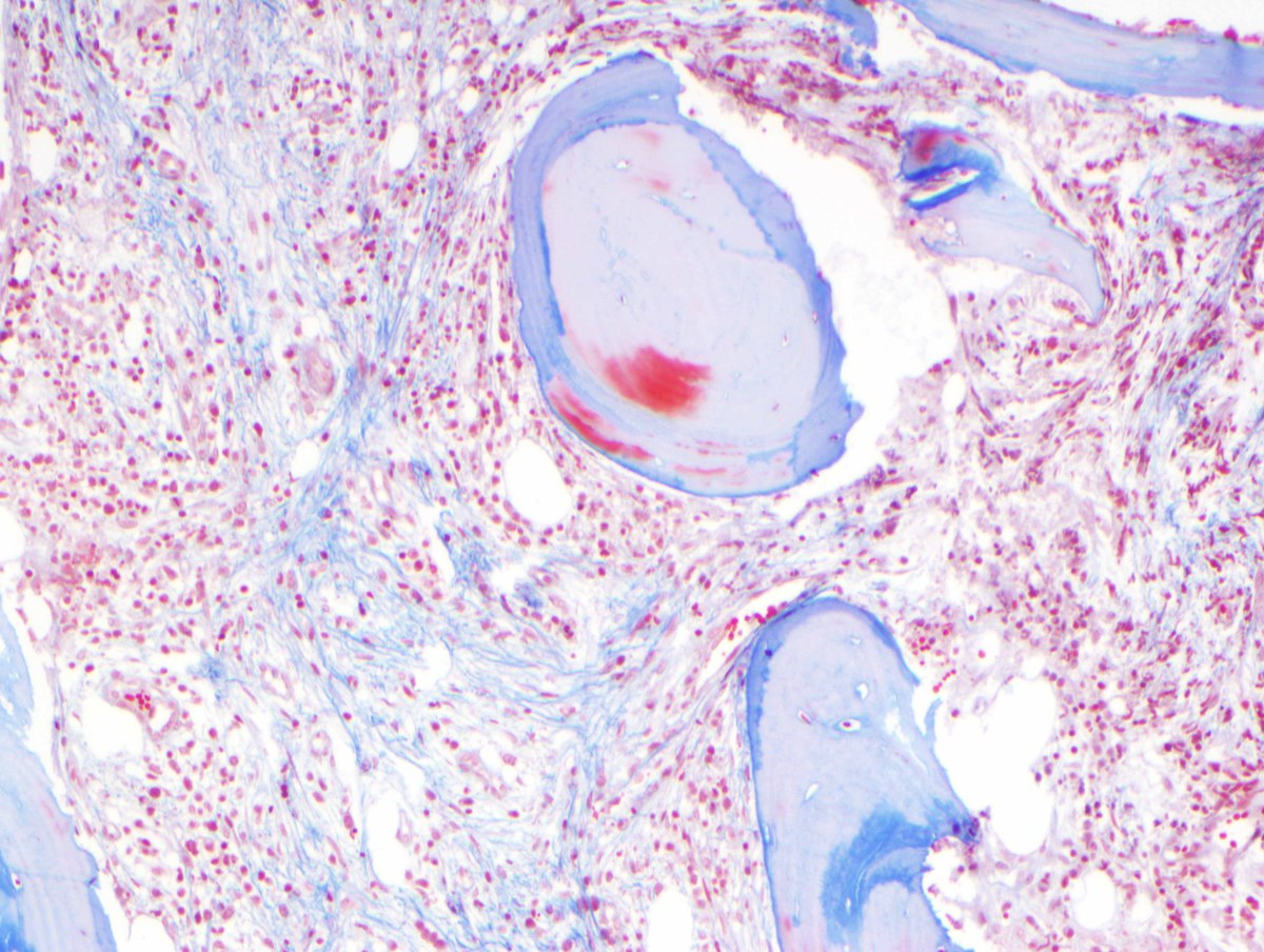G) Bone marrow collagen fibrosis (trichrome, 400x)